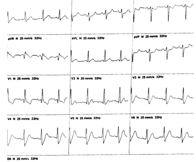 Paciente portador de múltiples factores de riesgo y antecedente previo de ACV isquémico que presenta patrón de Winter ECG + BRD que fue trombolizado tardíamente y que en la CCG de recate presenta suboclusión de la DA