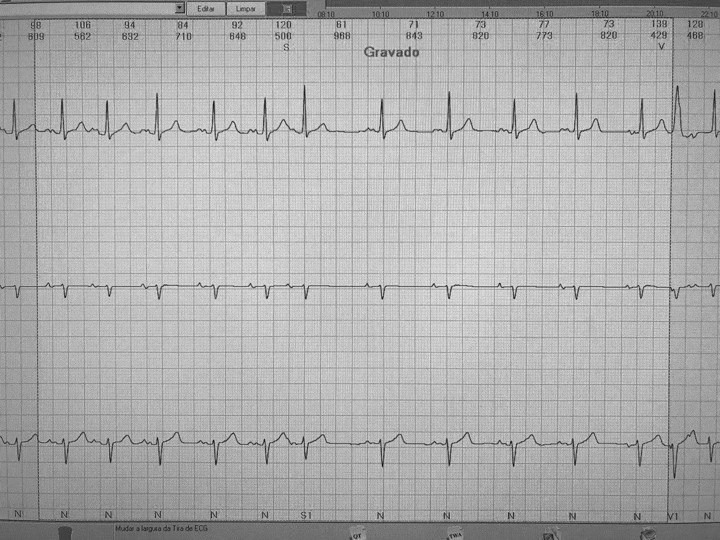 Paciente de 85 años con deterioro cognitivo a quién se realiza un ECG de Holter detectándose episodio de taquicardia auricular en contexto de BIA-A configurando un síndrome de Bayés
