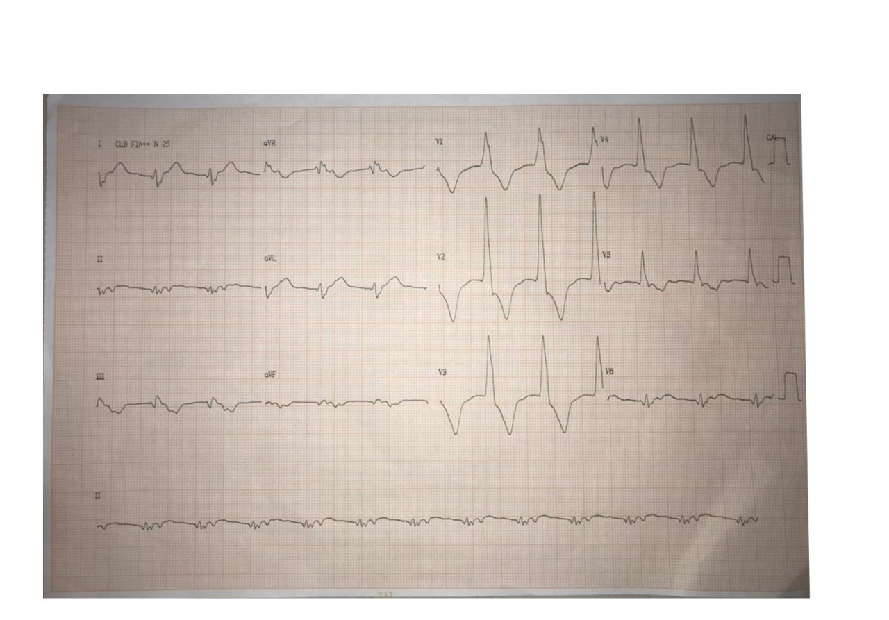 Varón de 49 años con tos, fiebre, congestión y disnea que evoluciona a severa insuficiencia respiratoria y en quién se constata COVID 19, que desarrolla una bradicardia de 39 lpm, con ecocardiograma normal y troponina negativa con ulterior presencia de RIVA, que se interpreta como compromiso de nódulo sinusal por el coronavirus