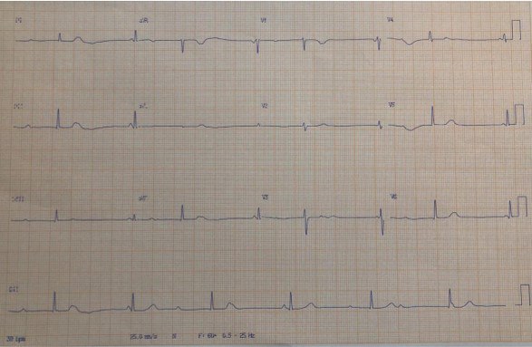 Mujer de 18 años con embarazo de 37 semanas que ingresó para realizar una cesárea por sufrimiento fetal cuyo ECG presenta un BAVC congénito