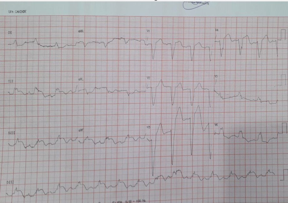 Varón que consulta por episodio de ángor cuyo ECG presenta un BCRI e IAM inferior (aplicando los criterios de Sgarbossa modificados por Smith) por enfermedad multivasos + oclusión total de CD