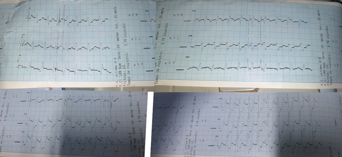 Paciente masculino que comienza con disnea súbita, que progresa a EAP debiendo ser intubado durante su translado, realizándose CCG que muestra enfermedad de tres vasos, optándose por angioplastia a la CD