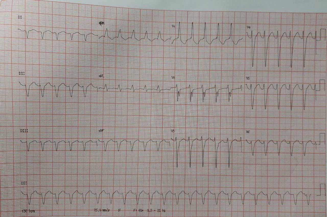 Mujer de 82 años con cirugía de reemplazo de válvula mitral que refiere disnea progresiva y que presenta AA 2:1 con aberrancia, recibiendo adenosina EV que logra reversión transitoria