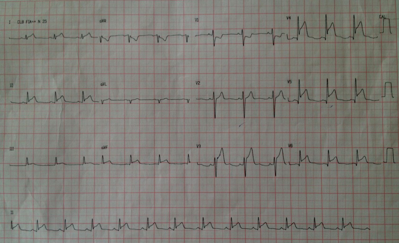 ECGs diarios consecutivos de paciente de sexo masculino de 17 años con dolor precordial severo que dificulta la respiración, irradiado al hombro izquierdo acompañado de sudoración sugestivo de pericarditis
