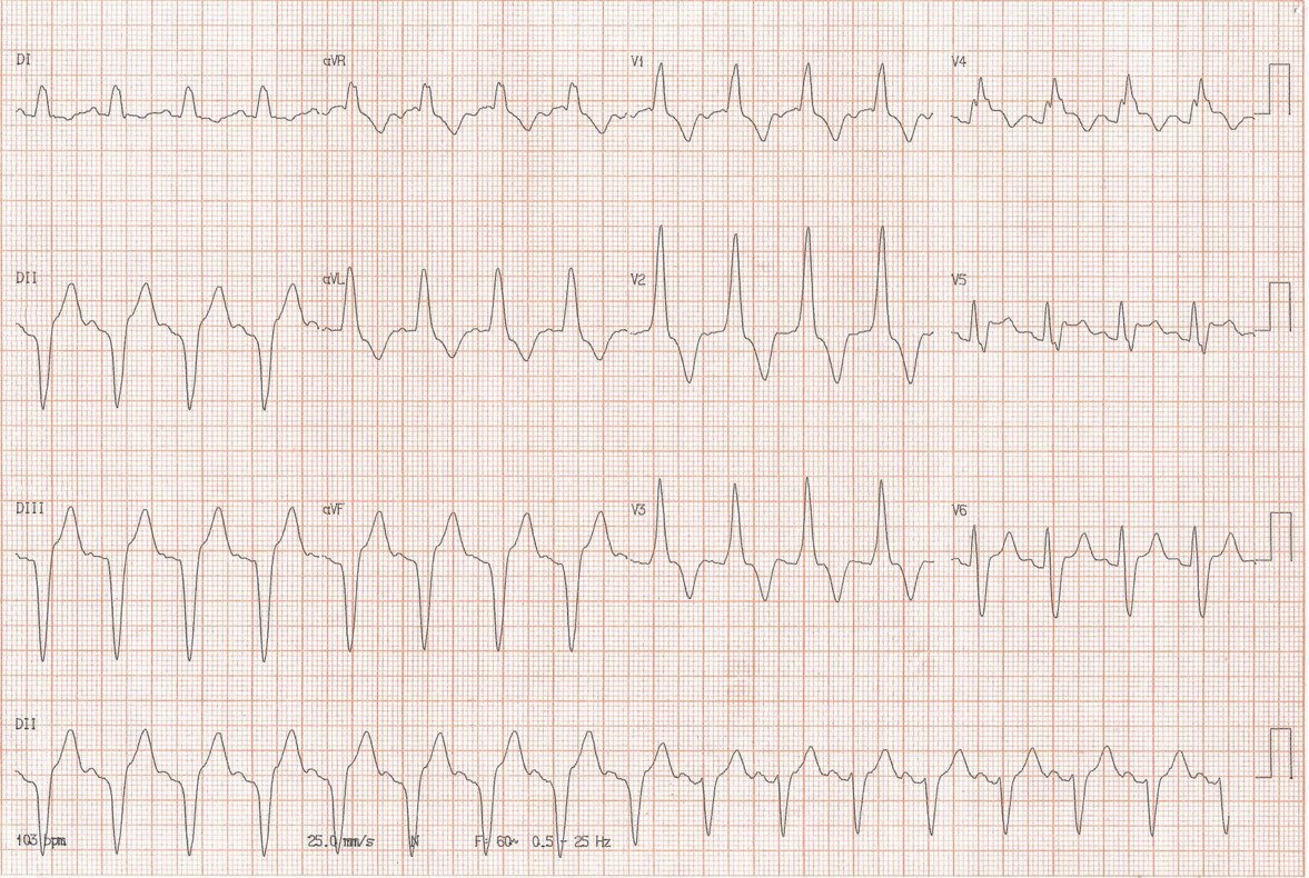 Varón 65 años con dolor precordial opresivo típico por oclusión proximal total de la DA a quién se practica angioplastia desapareciendo el BRD  completo + la onda R prominente en V1-V3, lo que sugiere un efecto beneficioso de la PCI tanto en la rama derecha + fascículo septal izquierdo