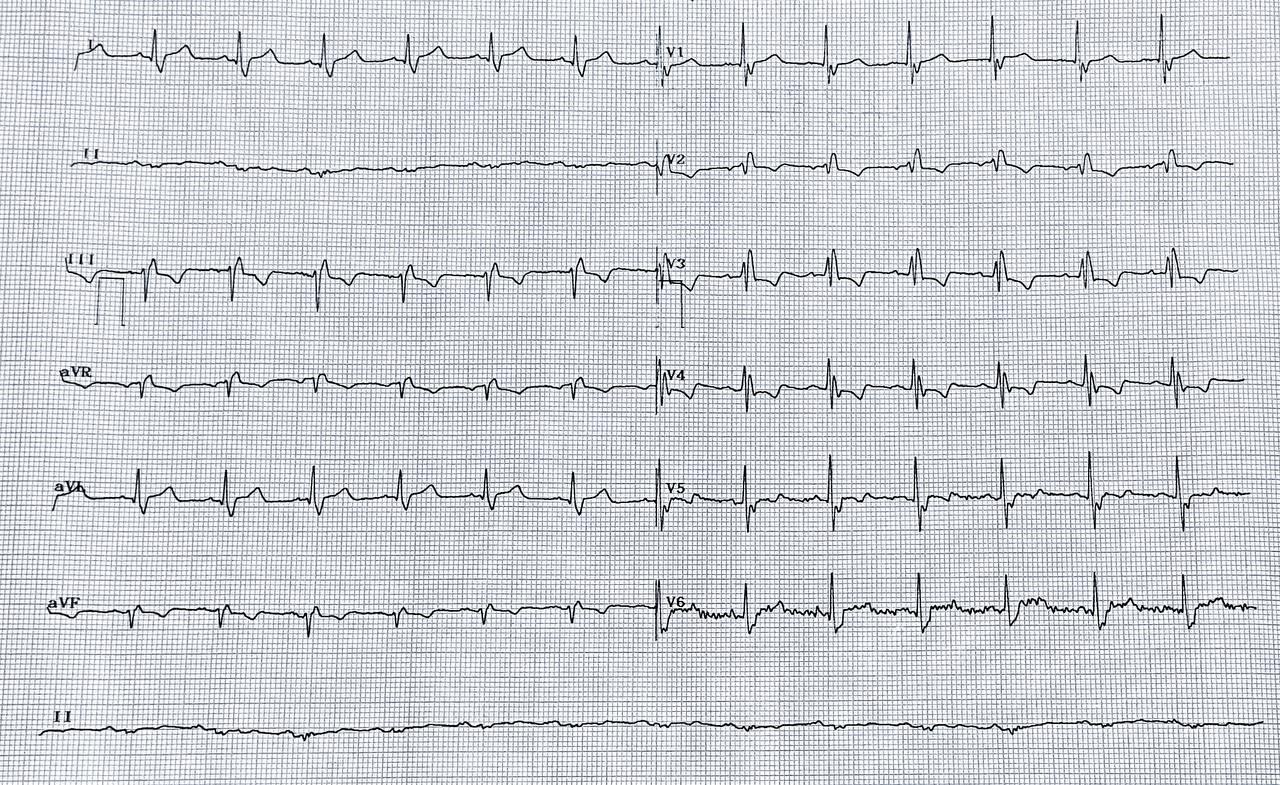 Paciente de 73 años, HTA DBT y dislipémico que presenta episodio de ángor intenso durante la alimentación. a quién se detecta troponina elevada y cuyo estudio angiográfico revela coronarias normales y una disección de aorta descendente (Stanford B) siendo sometido a 2 implantes de endoprótesis por acceso femoral de emergencia con éxito