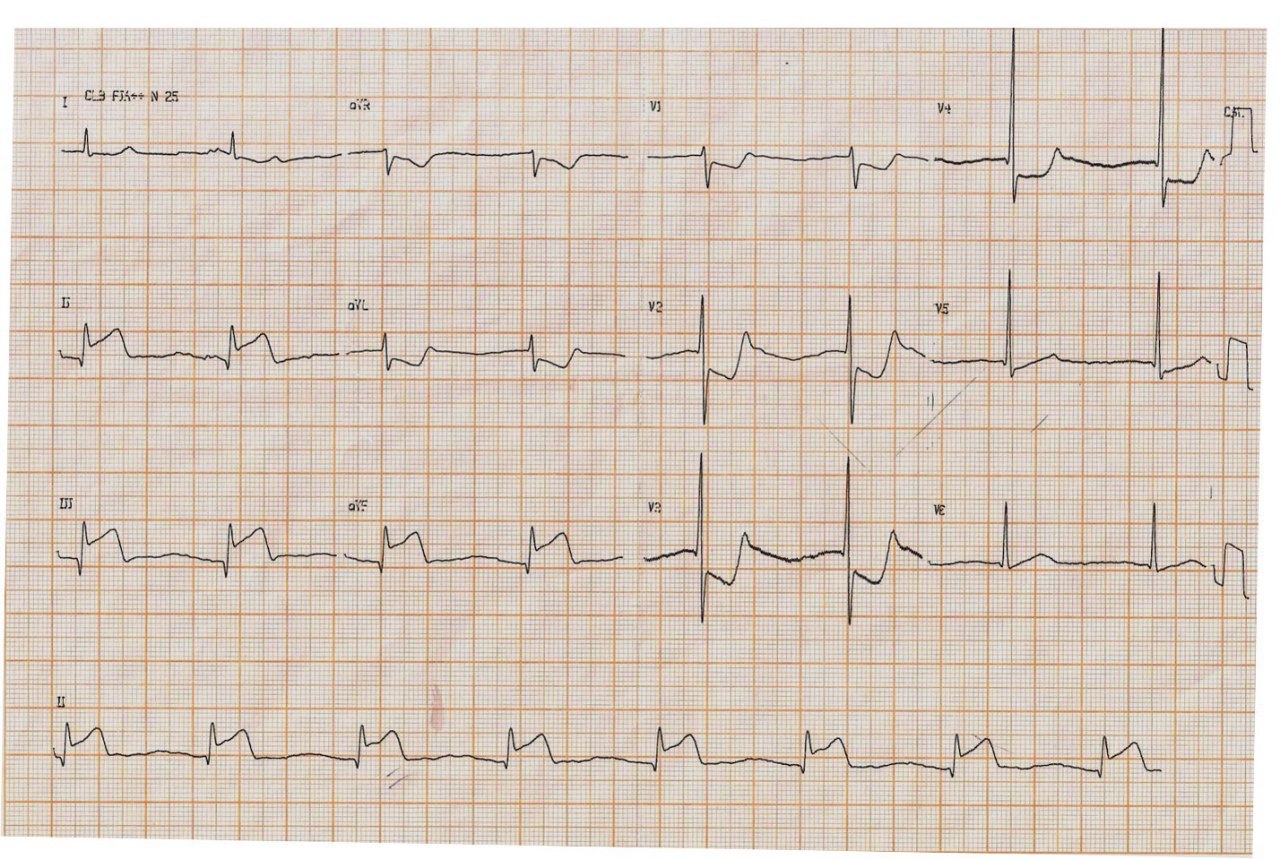 Hombre de 64 años con episodio de ángor que cursa IAM de cara inferior e infarto auricular agudo que muestra disociación AV con ritmo de escape unional, que presenta arteria coronaria derecha 100% ocluida practicándose ICP con implante de stent a CD con éxito, con signos ECGs de reperfusión.