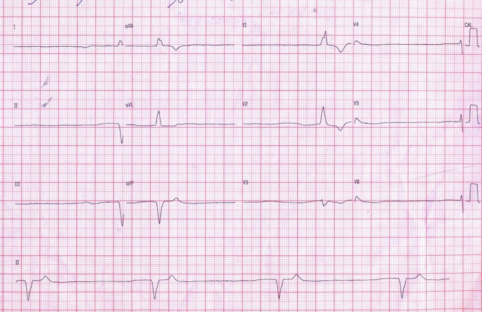 Mujer de 73 años, HTA y DBT con disnea y fatiga progresivas que presenta un ritmo de escape (posiblemente originado en la rama izquierda del haz) que presenta niveles muy altos de K y creatinina por iRC