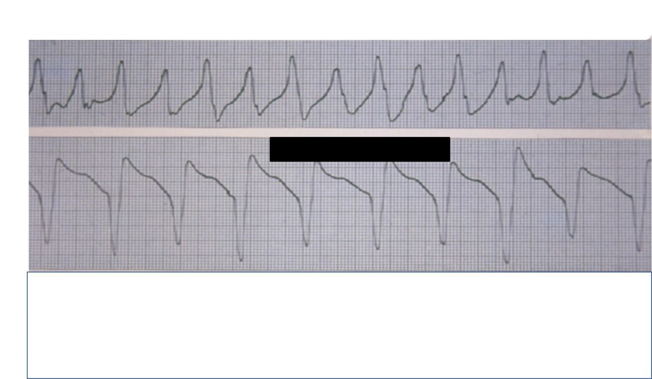 Mujer con epigastralgia y vómitos intermitentes a los que se agrega adinamia y episodio sincopal y es tratada con sulfato de maognesio que presenta K=1,2 digoxinemia elevada + hipomagnesemia
