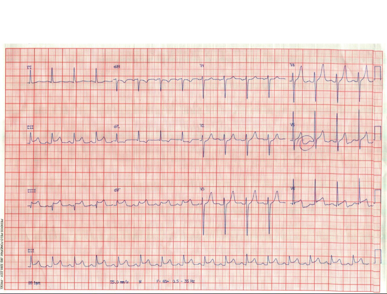 Mujer de 51 años con dolor ardiente precordial, disnea y náuseas y antecedente inmediato de cuadro febril, tos y esputo verdoso en la que se constata trombo en CD con reperfusión espontánea