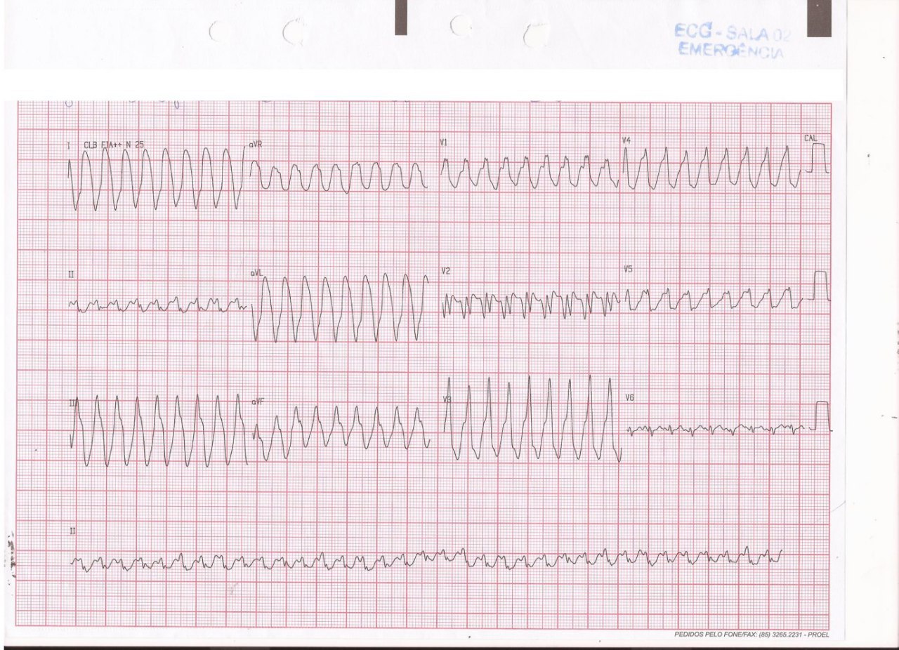 Hombre de 31 años usuario de cocaína con antecedente de IAM hace 7 meses que consulta por ángor y disnea que presentó episodio sincopal precedido de palpitaciones, que ingresa con TV que es cardiovertida, constatándose oclusión crónica total proximal de la DA y presencia de aneurisma