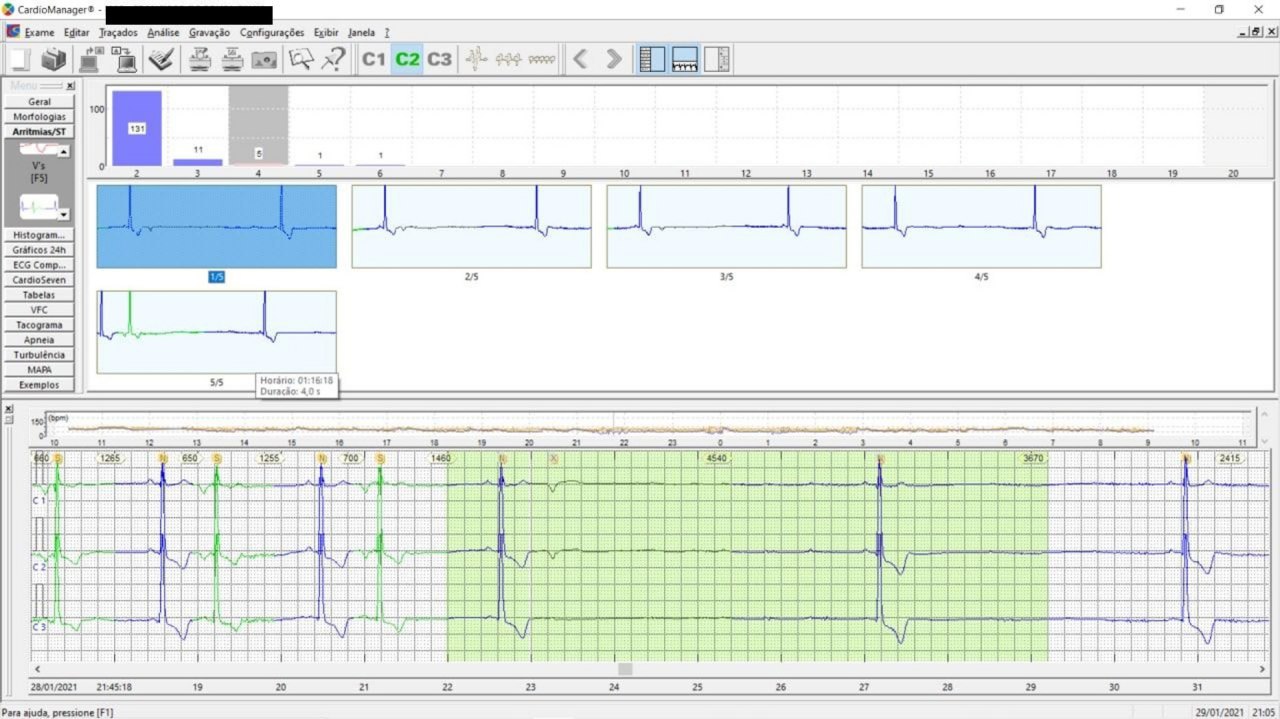 Paciente masculino de 52 años a quién se detectan períodos de asistolia durante anestesia de cirugía de hernia inguinal por lo cual se realiza Holter y polisomnografía confirmándose la presencia de apnea del sueño