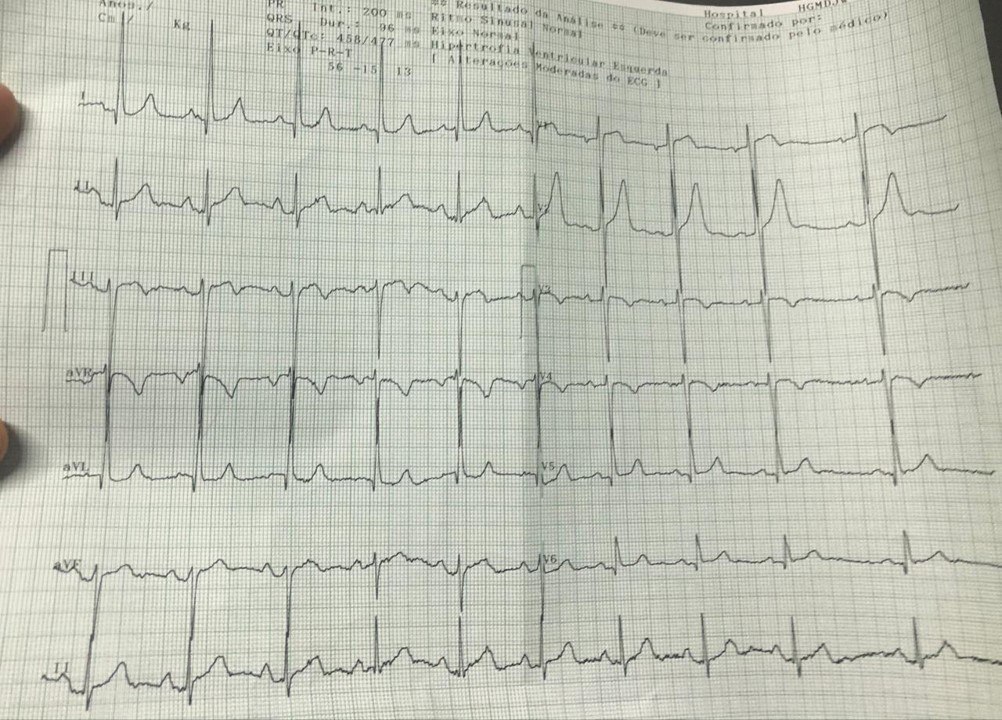 Paciente que comienza con episodio de ángor intenso con náuseas y vómitos con hallazgo de TCI ocluído + disección aorta proximal tipo A