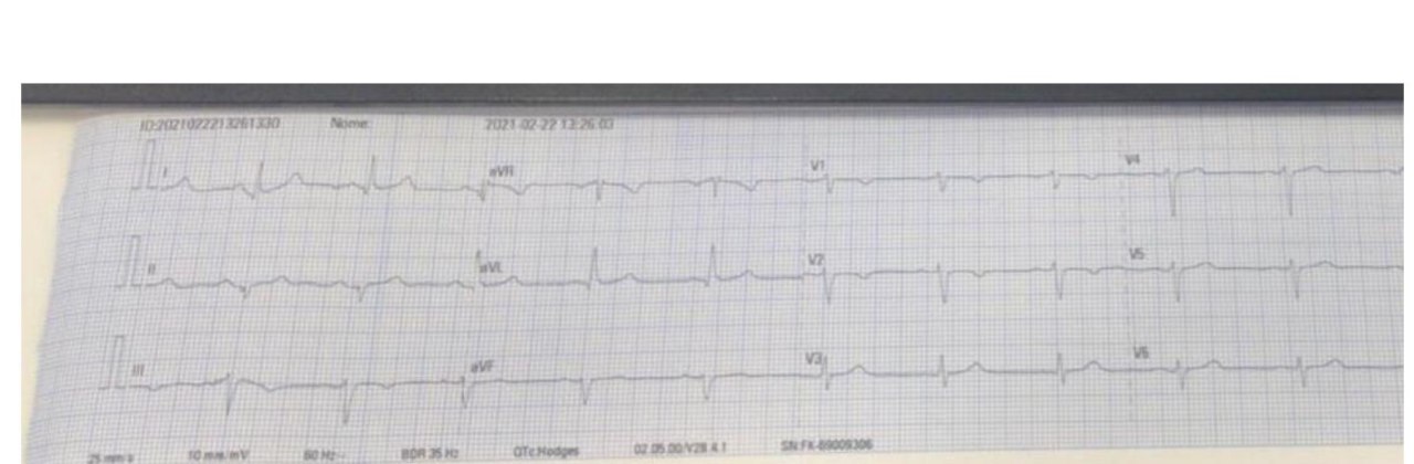 Hombre de 55 años, dislipémico con antecedente de haber cursado infeccción por COVID 19 que reingresa al Hospital por precordialgia, con troponina + y CCG normal, con zona de infarto en RNM, considerándose un MINOCA