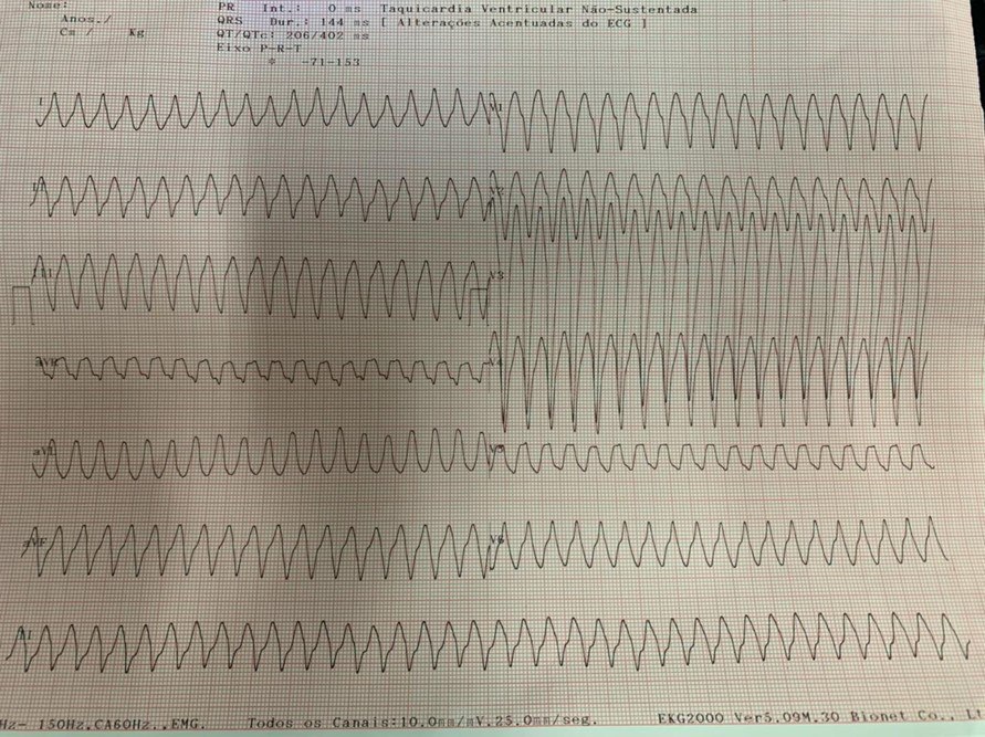 Masculino de 59 años tratado con atenolol, que presenta dolor de pecho y presíncope que presenta AA 1:1 con aberancia que espontáneamente pasa a 2:1, desapareciendo la aberancia