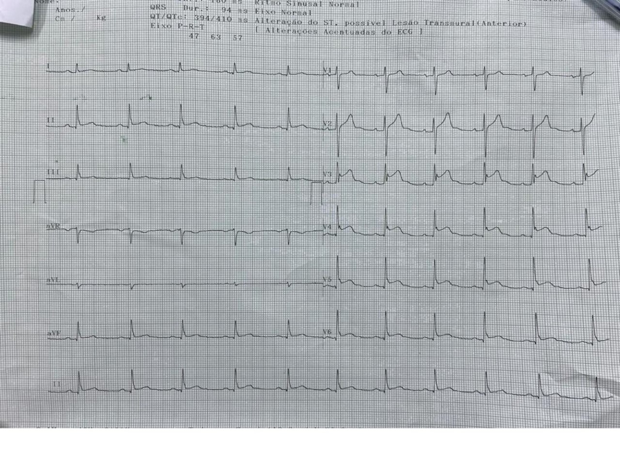 Masculino de 32 años que presenta episodio de ángor prolongado, en quien se constata presencia de trombo proximal en la DA