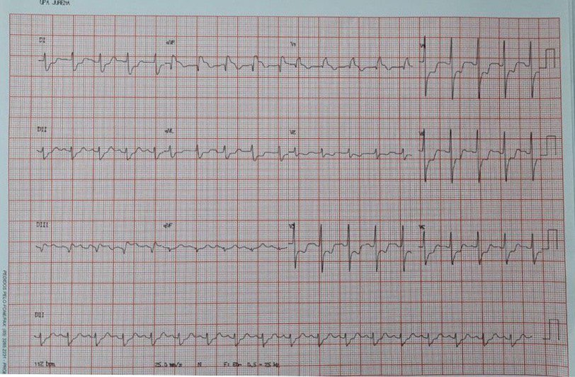 Paciente masculino de 66 años, hipertenso, diabético y alérgico a la aspirina, en quién se constata enfermedad multivasos con obstrucción severa de la DA a la salida de la rama septal programándose cirugía de revascularización