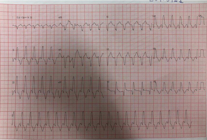 Mujer 60 años con historia previa de cardiopatía isquémica con revascularización quirúrgica que presenta TV con morfología QR (pero no QS), mostrando que su presencia indica una cicatriz en el miocardio generalmente causado por infarto de miocardio previo