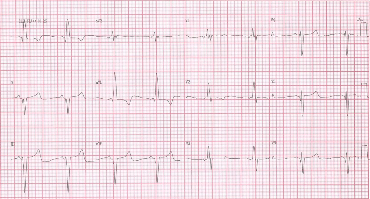 Mujer de 46 años con antecedentes familiares de nefropatía genética,  que refiere palpitaciones, disnea, malestar en el pecho, que presenta miocardiopatía hipertrófica con fibrosis difusa, y estenosis subaórtica leve a moderada, con análisis genético positivo para enfermedad de Fabry