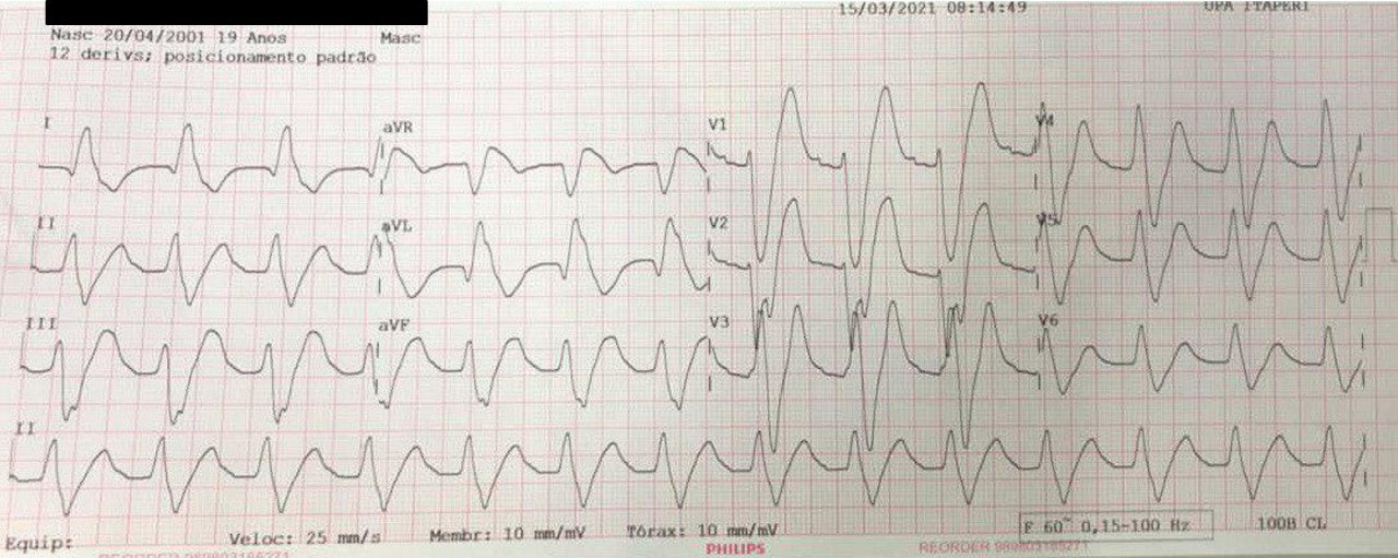 Paciente de 19 años que ingresa en paro cardiorespiratorio con episodios de FV con antecedente inmediato de libación alcohólica y uso de spray basado en cloruro de etilo, con acidosis, recibiendo bicarbonato de Na a pesar de lo cuál el cuadro fue irreversible