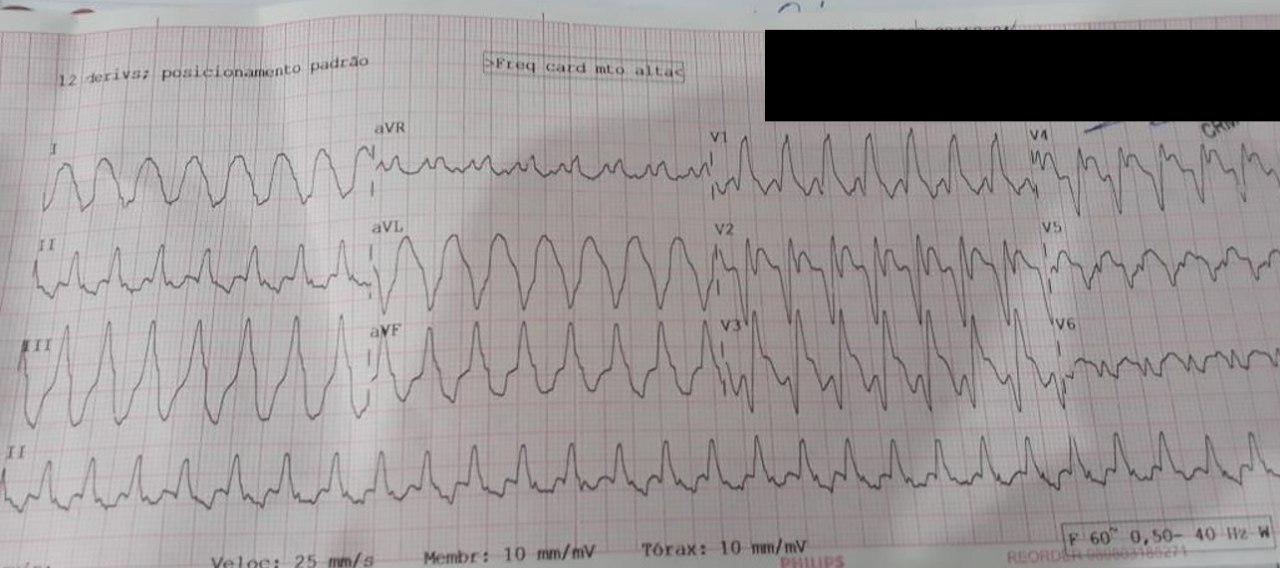 Varón de 61 años que concurre con cuadro de inestabilidad hemodinámica que se corresponde a la presencia de una taquicardia de QRS ancho (TV) que logra revertirse luego del 3r intento de CVE, con patrón QR en las precordiales que indica la presencia de una cicatriz y cuya CCG reveló una oclusión total crónica de la arteria descendente anterior