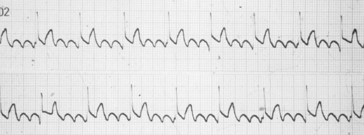 Paciente portador de aleteo auricular crónico con taquicardia independiente no paroxística de la unión A-V (frecuencia, 75 / min) que produce una disociación AV completa  inducida por digital