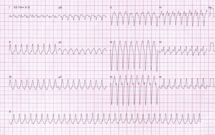 Paciente masculino de 39 años que a posteriori de libación alcohólica presentó dolor de pecho y palpitaciones que se corresponden con una TVMS