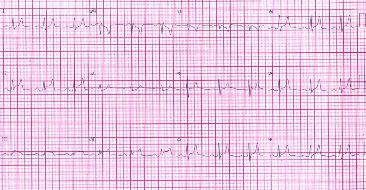 Varón de 48 años DBT con disnea aguda y dolor torácico presentando ritmo sinusal con ondas T altas, picudas y estrechas + elevación del segmento ST en cara inferior, con potasio muy elevado, debido a insuficiencia renal aguda por lo que recibe gluconato de Ca y posteriormente sometido a hemodiálisis