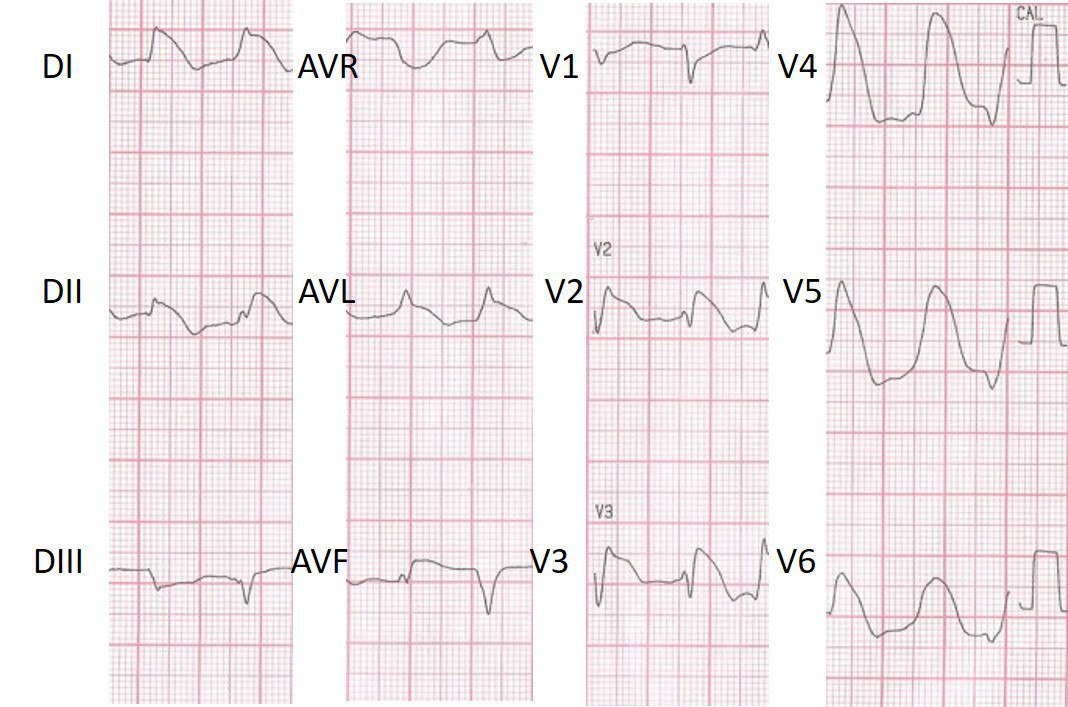 Mujer de 60 años sin comorbilidades que presenta malestar retroesternal después de estrés emocional cuya clínica y ECG son sugestivos de síndrome de Takotsubo con recuperación completa del VI al cabo de cuatro días