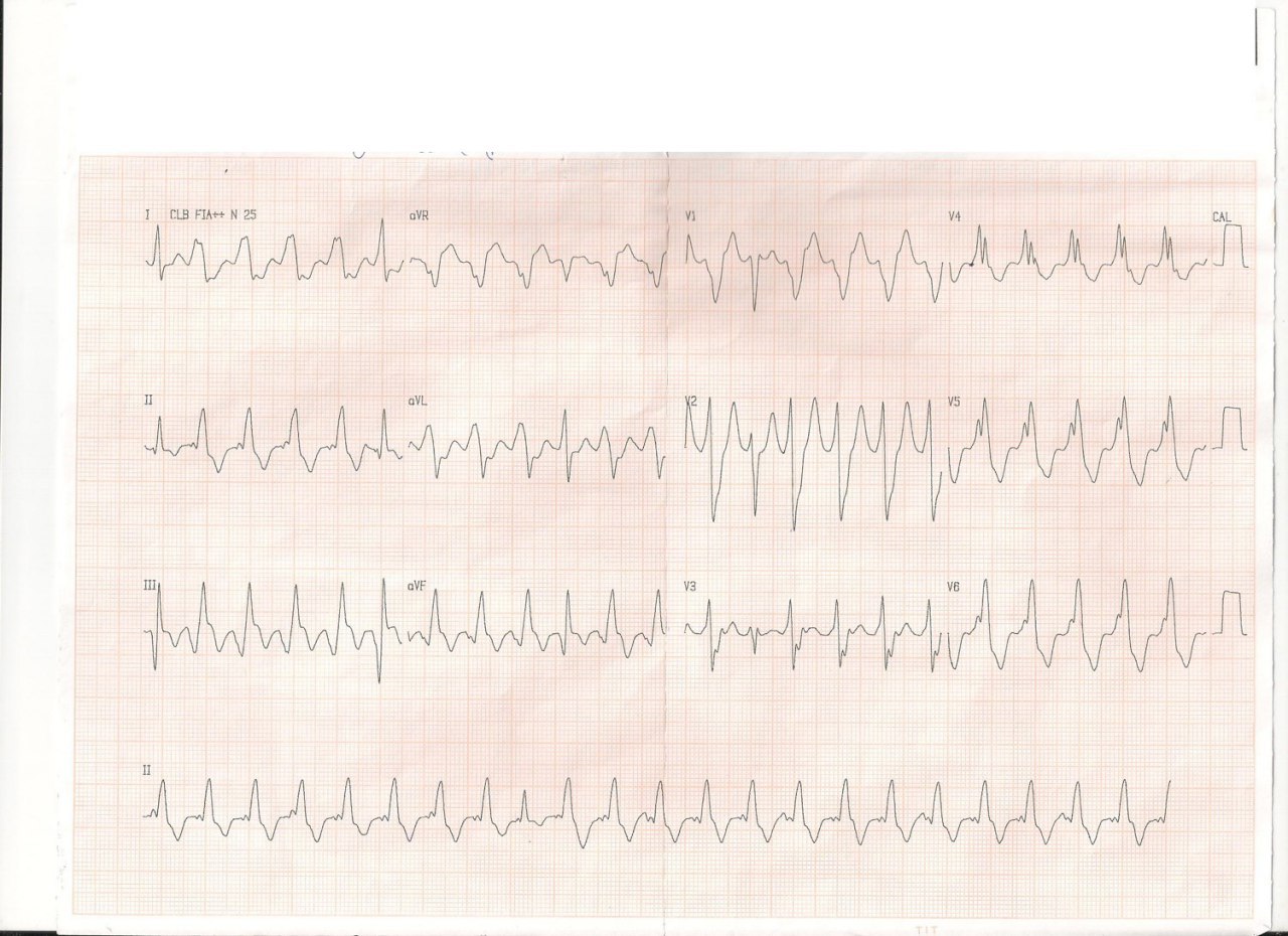 Paciente masculino de 74 años con palpitaciones y disnea súbitas con antecedentes de SCACEST en cara interior e implante de stent hace 9 meses y desarrollo de gran aneurisma inferior que presenta TV