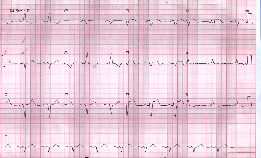 Mujer de 69 años con antecedentes de HTA e hiperlipidemia que presenta episodio de dolor toráccico siendo tratada con AAS y clopidogrel constatándose oclusión total de la DA, decidiéndose intervención coronaria percutánea (ICP) con resolución del trastorno de conducción intraventricular a pesar de flujo final TIMI II
