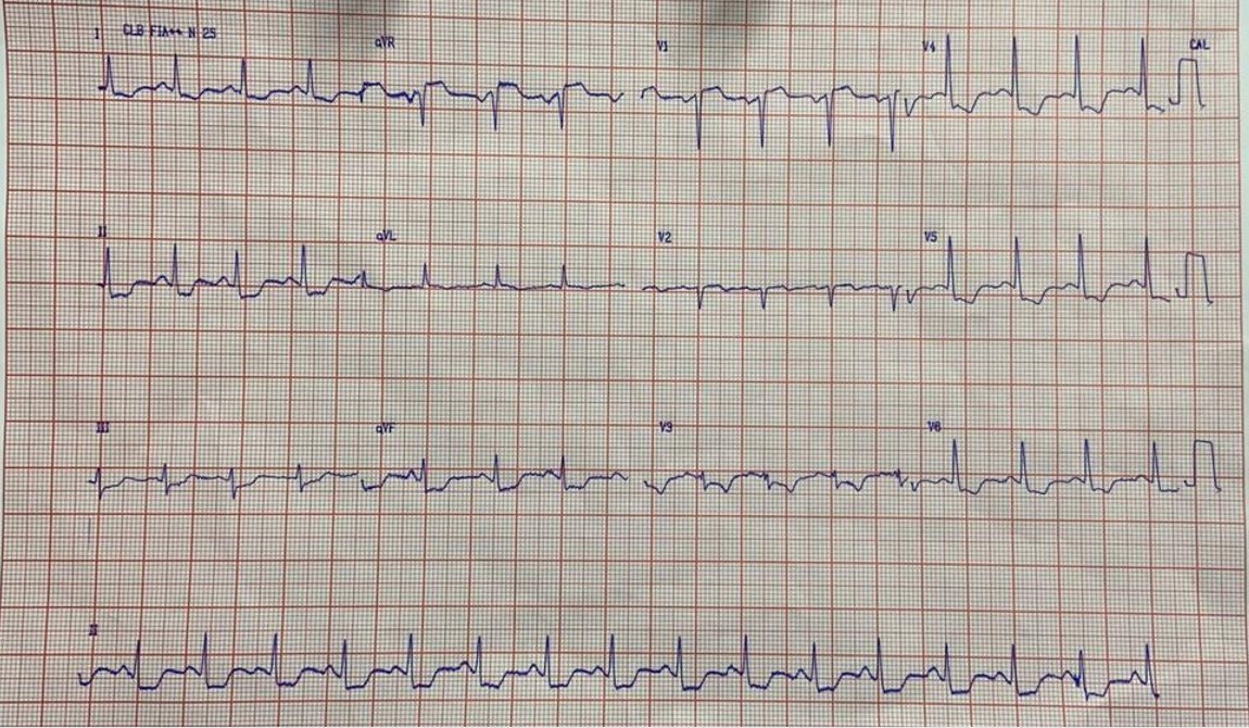 Mujer de 61 años HTA DBT y dislipémica que presenta ángor progresivo de esfuerzo que se hace de reposo luego de abandonar el tratamiento, constatándose enfermedad de tres vasos y compromiso de TCI