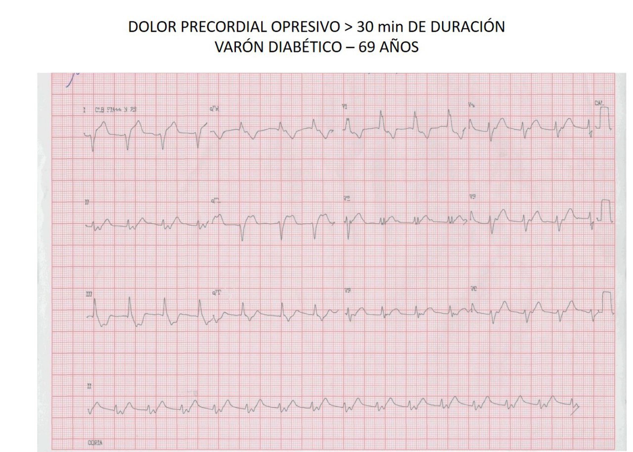 Paciente de 69 años con ángor que presenta RIVA con imagen de BRD que revierte espontáneamente como signo de reperfusión