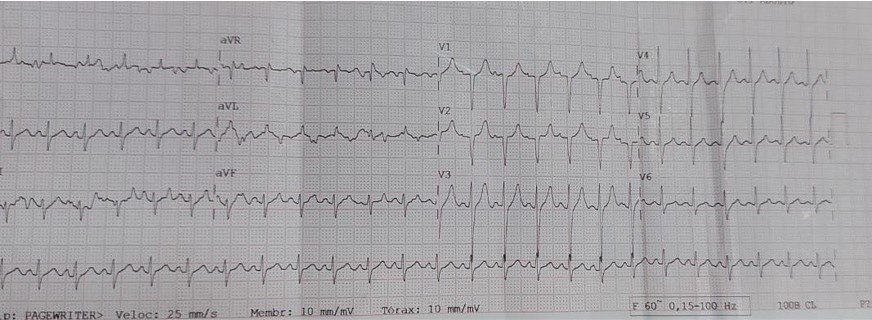 Masculino de 48 años cursando COVID 19  con marcada elevación nivel de troponina I que desarrolló shock con acidosis metabólica grave, con  disfunción biventricular, edema miocárdico difuso y derrame pericardico por probable miocarditis fulminante
