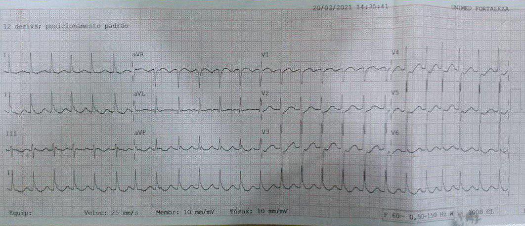 Varón de 75 años con disnea, tos y fiebre (39 C) por COVID 19 que determina neumonía intersticial severa bilateral, con peoría que corresponde al ECG Nº 1 con AA 2:1 que revirtió con amiodarona EV con prolongación del QTc y extrasistolia nodal.
