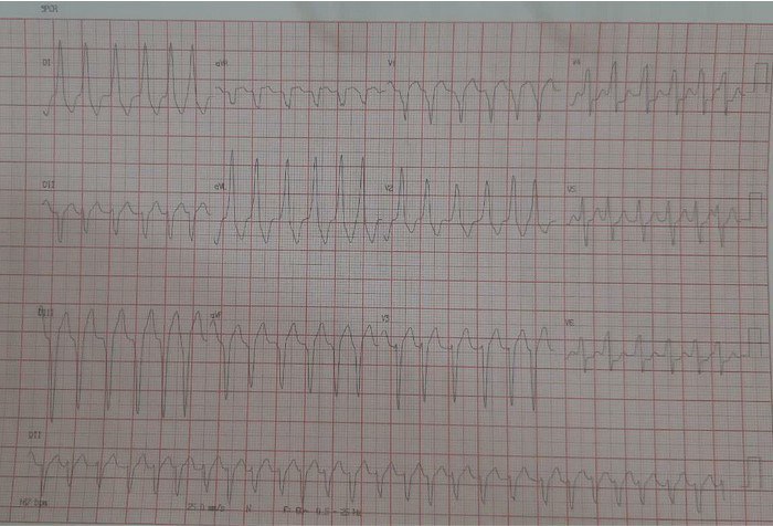 Varón de 19 años con palpitaciones recurrentes por WPW