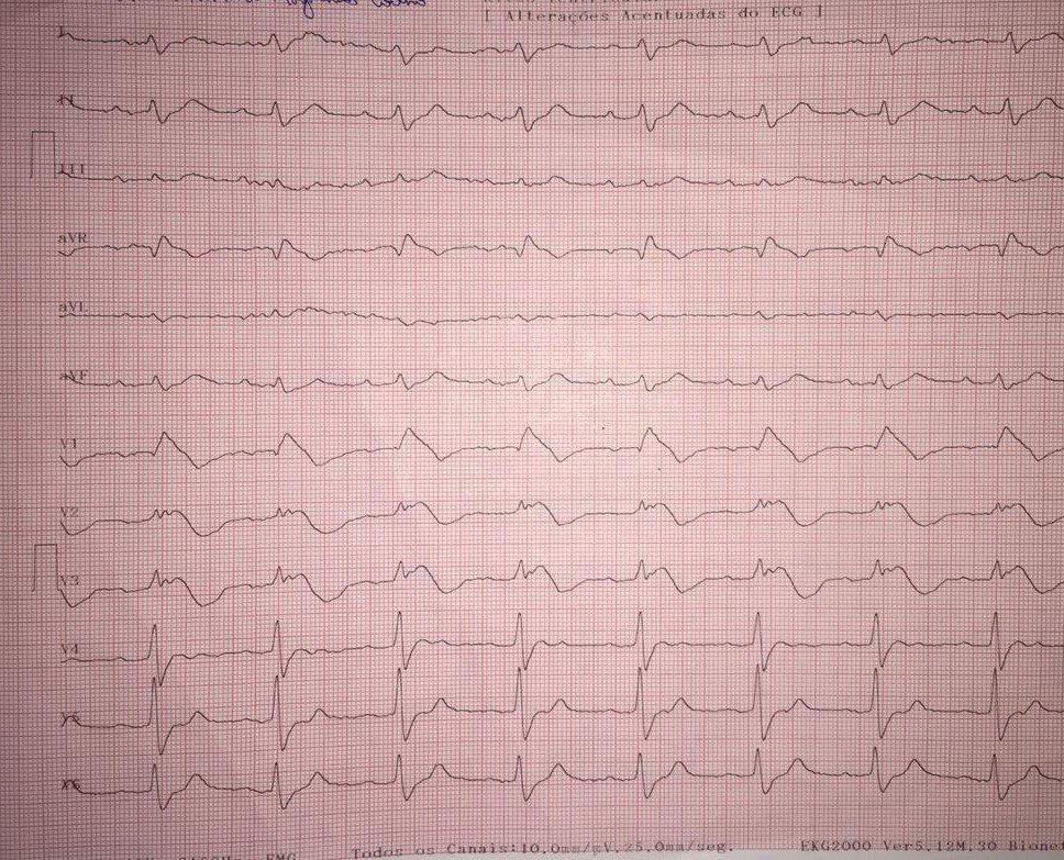 Mujer de 67 años con historia febril y tos con progresivo empeoramiento de la disnea y dolor torácico con hisopado nasofaríngeo negativo (¿falso negativo?) para COVID-19 que presenta patrón ECG de Brugada tipo 1