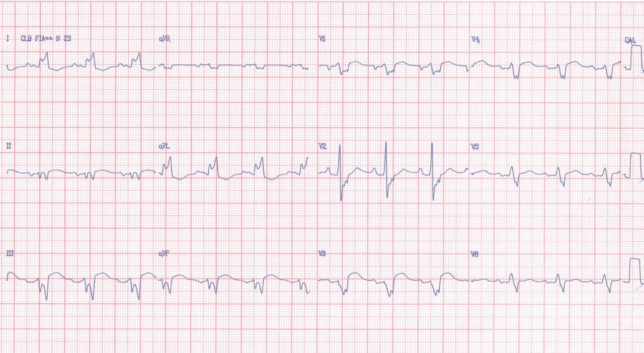 Mujer de 36 años con ICC clase IV y antecedente de una hermana fallecida a la misma edad con idéntica enfermedad. que se trata de un miocardio no compactado
