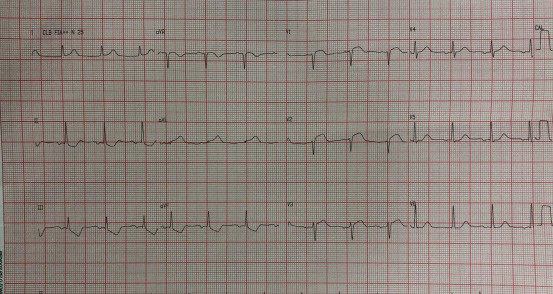 Paciente cursando SCA que presenta obstrucción del 100% de la DA y en quién se observa BIA-A, motivo de discusión acerca de la necesidad de anticoagulación por riesgo de desarrollo de FA
