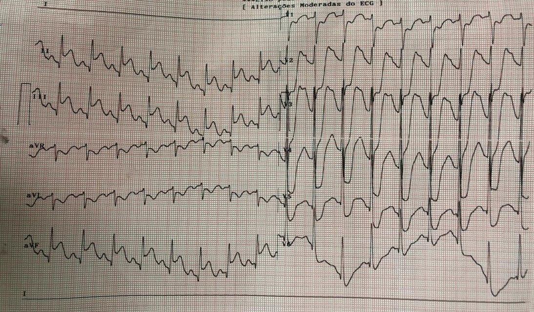 Paciente de 64 años con dolor torácico y síncope que repite al día siguiente con incremento de la intensidad, asociado a cefalea y náuseas realizándose angioplastia de CD, presentando BAVC transitorio que se visualiza en el monitor