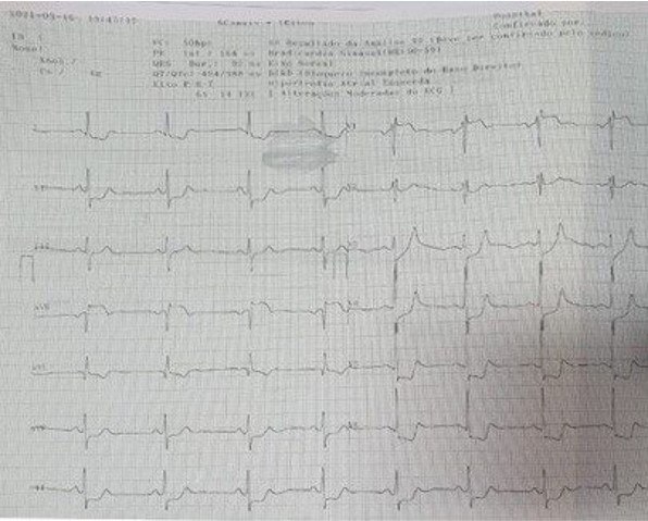 Paciente masculino de 54 años, DBT y tabaquista con ángor de reciente comienzo que presenta paro cardíaco antes de someterse a CCG por probable lesión de TCI