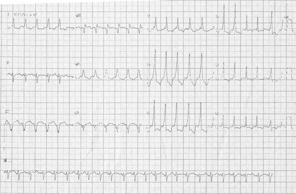 Mujer de 89 años que es ingresada por COVID 19  y en quién se detecta FA preexcitada