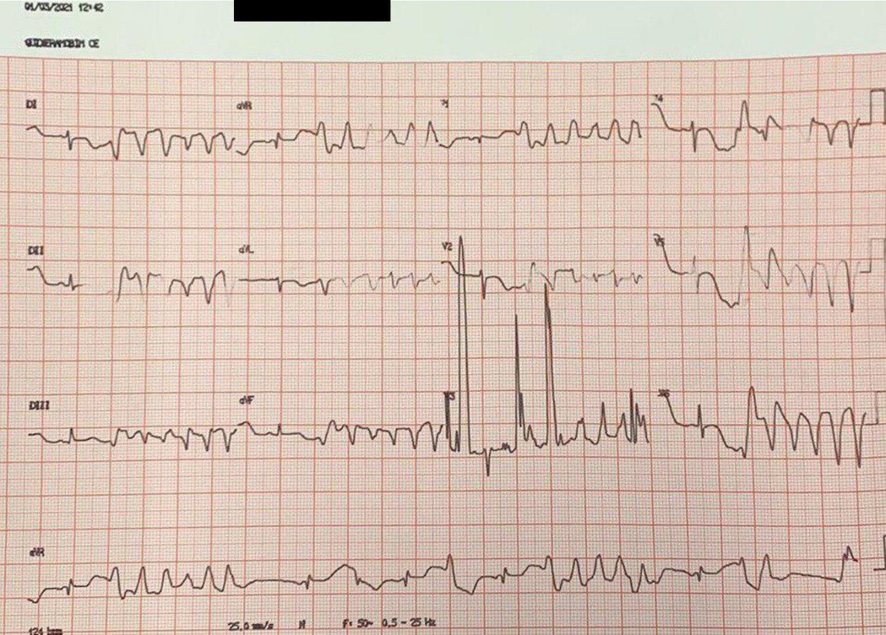 Mujer de 49 años cursando neunonía por COVID 19 tratada con azitromicina que presenta TdP y macroalternancia de la  onda T indicándosele sulfato de Mg