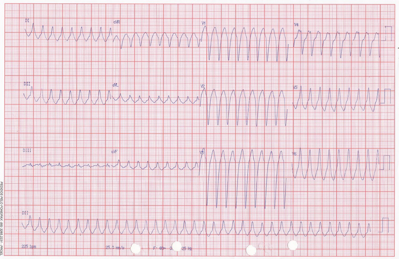 Mujer 27 años con palpitaciones que presenta TRAVO por vía accesoria lateral izquierda