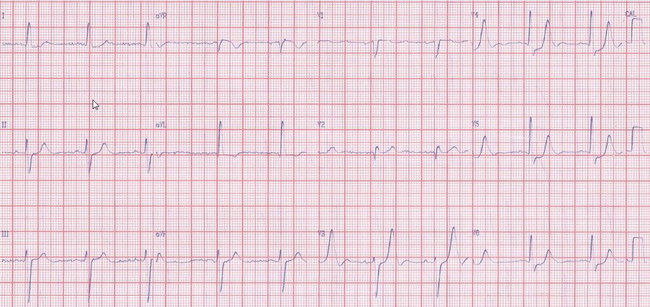 Varón de 57 años con dolor precordial opresivo de nueva aparición 2 horas antes del ingreso que fue interpretado como SCA sin supradesnivel ST, por probable enfermedad de tres vasos sin resolución del problema agudo de la DA, el paciente desarrolló una isquemia global que provocó un shock cardiogénico y actividad eléctrica sin pulso