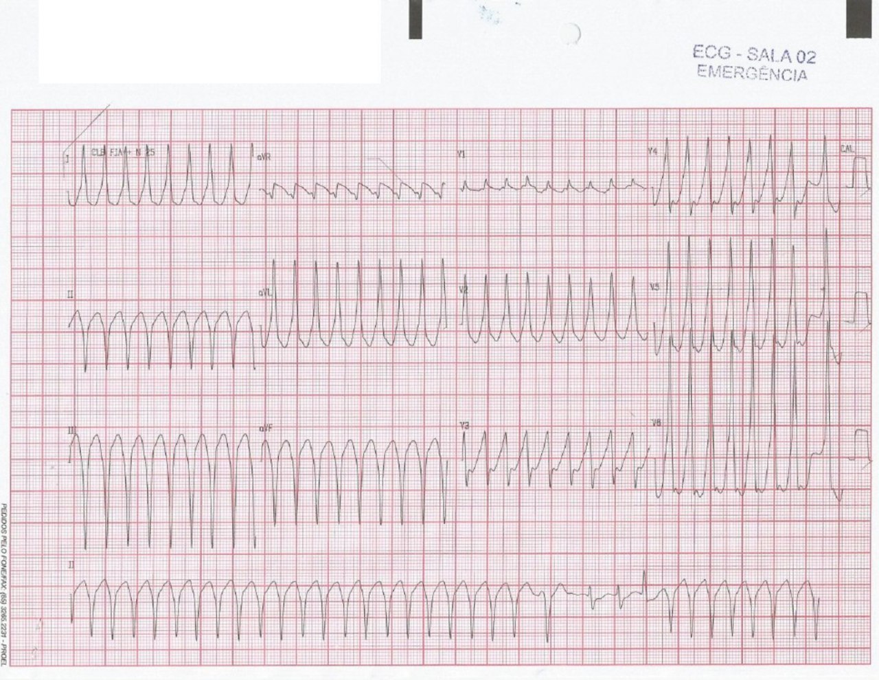 Hombre de 72 años que consulta por palpitaciones precedidas de dolor precordial y seguidas de síncope con antecedente de episodio similar hacía 5 años, que presenta hipocinesia de pared ínferolateral, HVI y reflujo mitral, con disfunción del músculo papilar y oclusión 100% de la Cx
