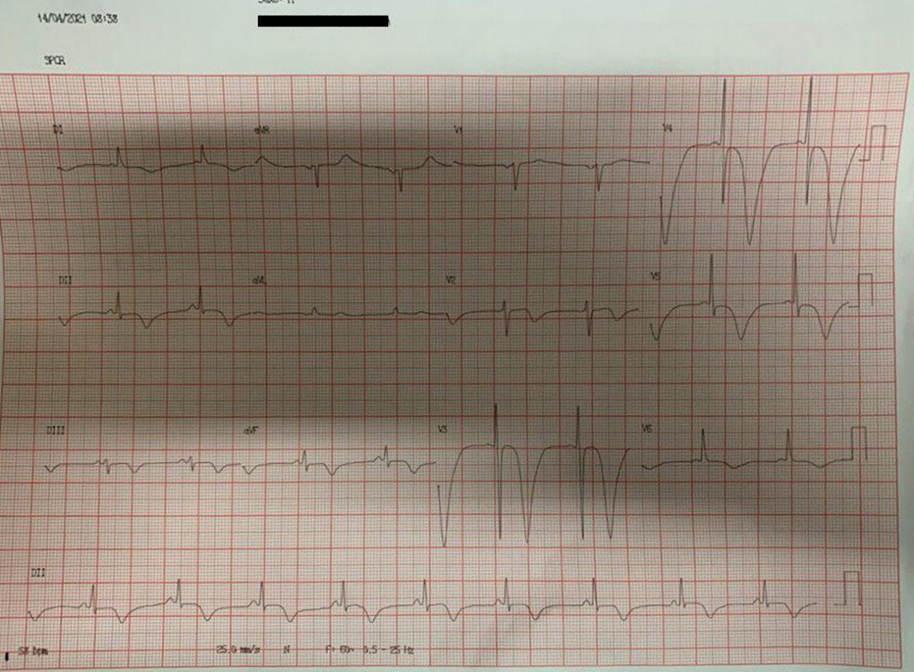 Hombre de 59 años que presenta dolor precordial opresivo desde hace tres días, con troponinas elevadas, cuyo ECG muestra ondas T negativas masivas indicativas de compromiso severo de DA, 1º diagonal, Cx y CD