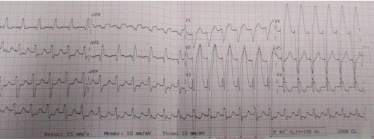 Joven de 28 años que presenta palpitaciones atribuibles a la presencia de AA 2:1 que revierte espontáneamente