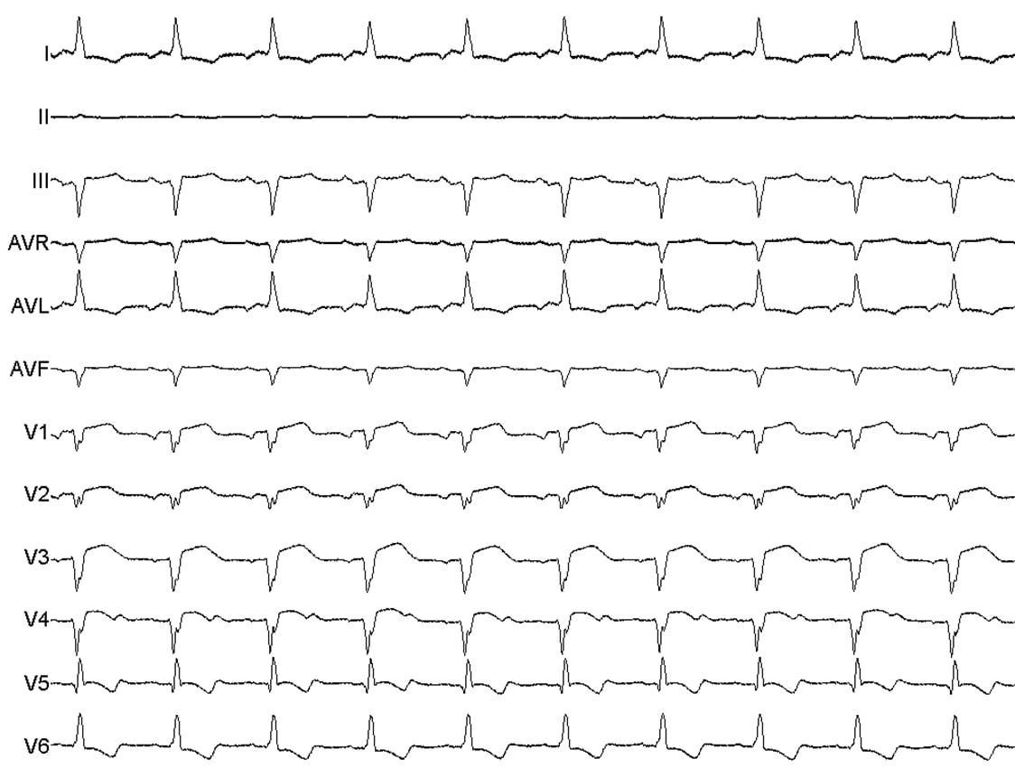 Paciente portador de miocardiopatía chagásica con FEVI = 25% y DAI multisitio implantado en profilaxis secundaria, medicado con amiodarona, que evoluciona con múltiples episodios de taquicardia ventricular monomórfica sostenida con descargas apropiadas del CDI. Los electrodos del hemicuerpo derecho se hallan intercambiados
