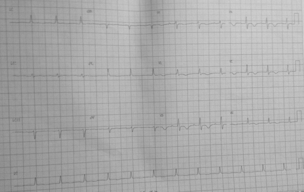 Mujer hipertensa de 65 años que ingresó tras el inicio agudo de hemiparesia y disartria con trastornos neuropsicológicos (afasia expresiva, disartria, deterioro de la memoria verbal) y alteraciones electrocardiográficas, representadas por inversión de la onda T detectándose la presencia de un trombo en arteria carótida